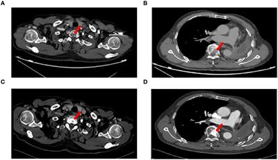 Double-dose osimertinib combined with intrathecal injection of pemetrexed improves the efficacy of EGFR-mutant non-small cell lung cancer and leptomeningeal metastasis: case report and literature review
